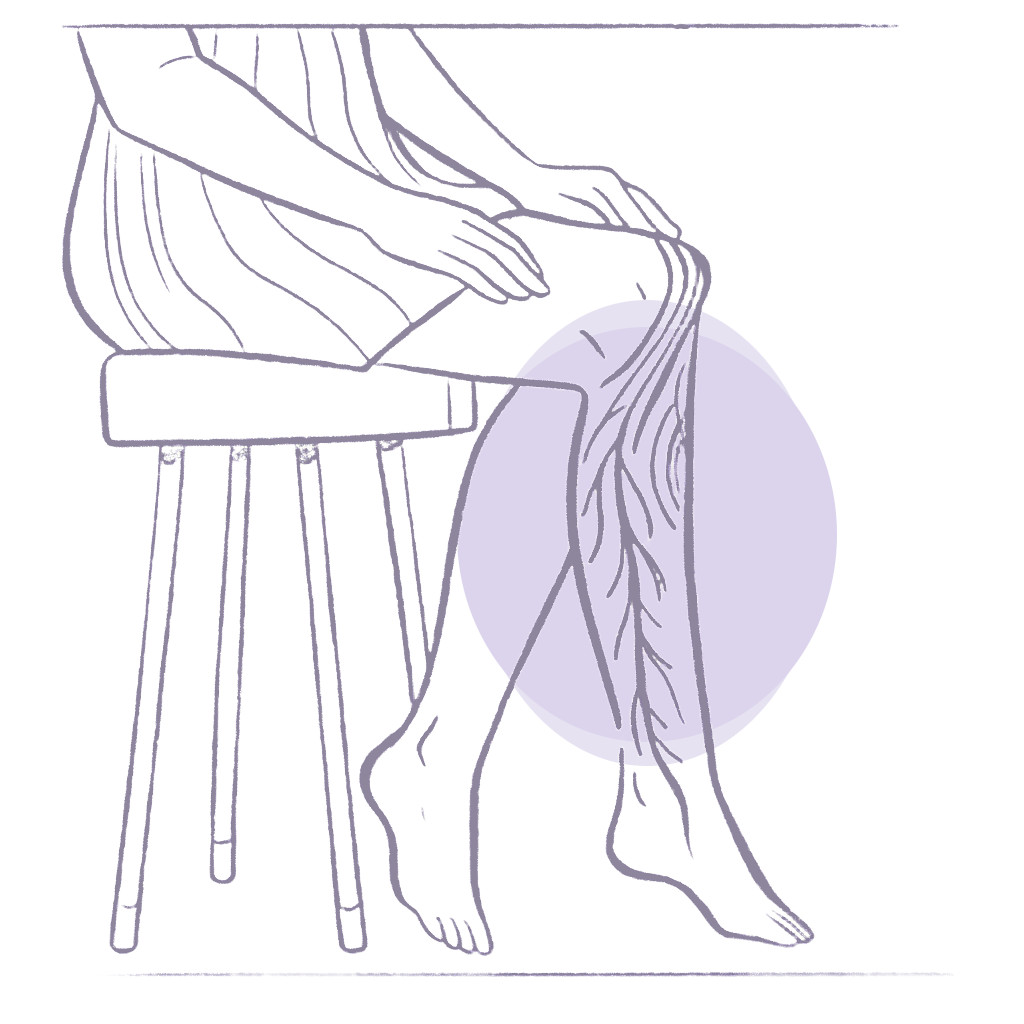 Recovery after Sclerotherapy Featured Image