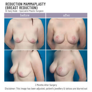 Breast Reduction by Dr Gary Kode Melbourne