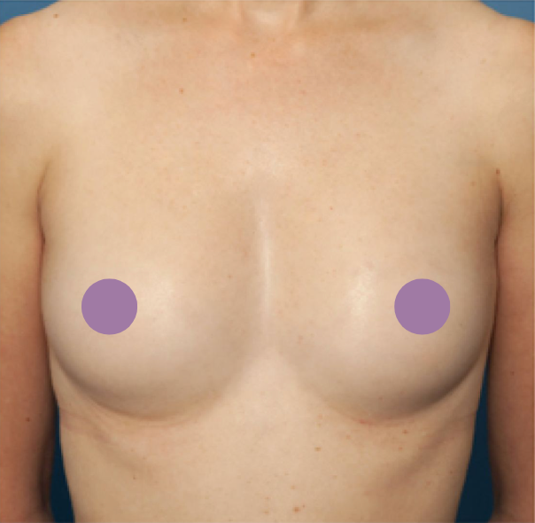 cs1_liposuction_face_before-img