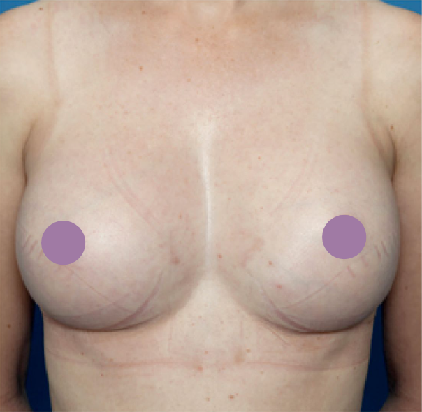 cs1_liposuction_Face_after-img