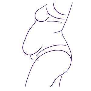 Apronectomy Meclinic- Image