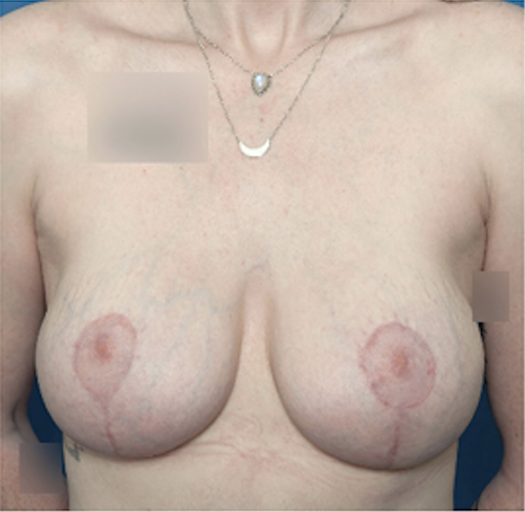 cs1_liposuction_Face_after-img
