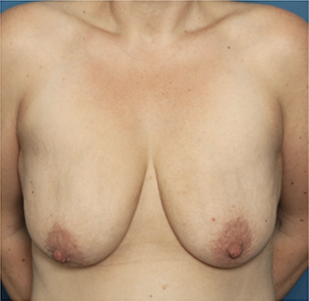 cs1_liposuction_face_before-img