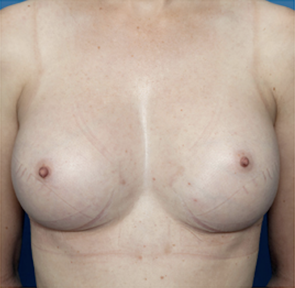 cs1_liposuction_Face_after-img