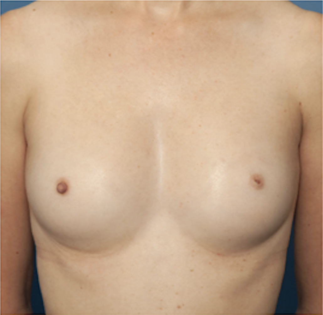 cs1_liposuction_face_before-img
