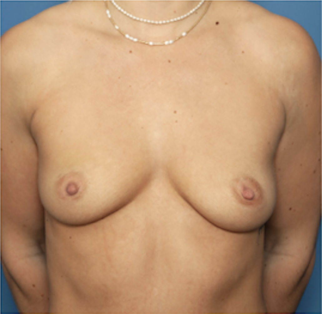 cs1_liposuction_face_before-img