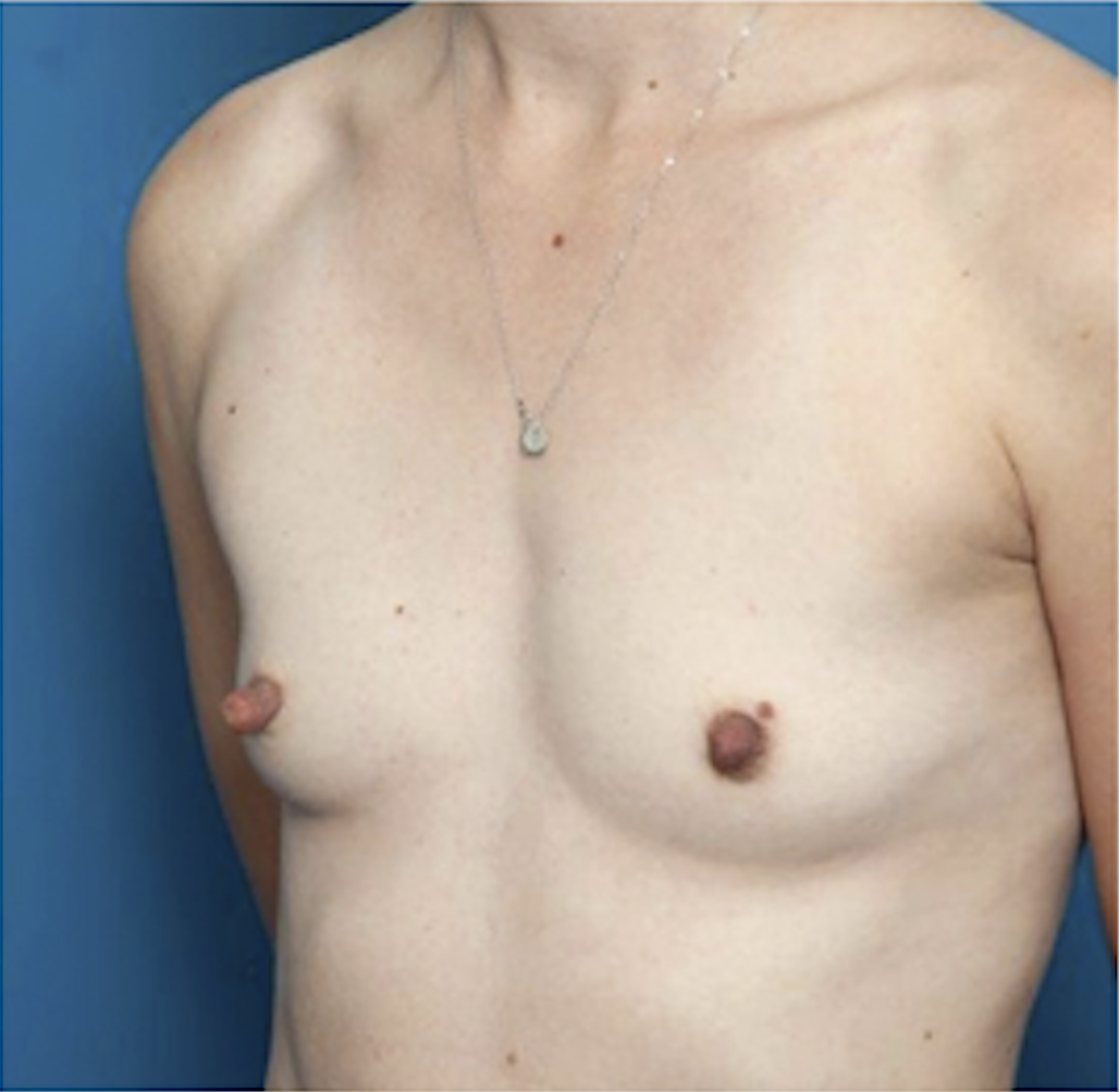 cs1_liposuction_face_before-img
