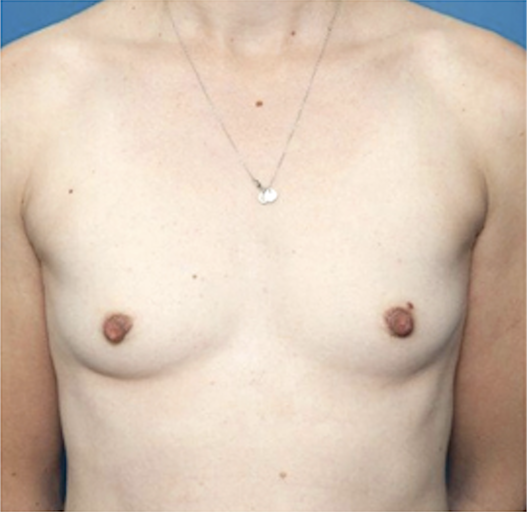 cs1_liposuction_face_before-img