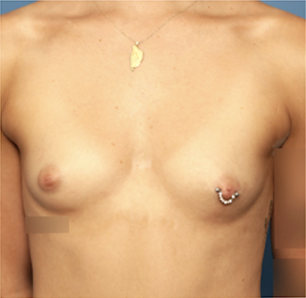 cs1_liposuction_face_before-img