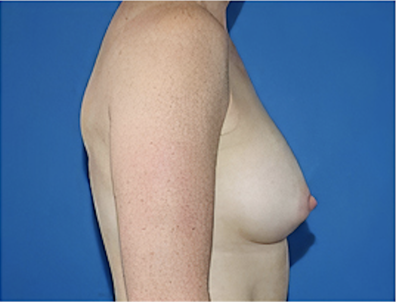 cs1_liposuction_Face_after-img