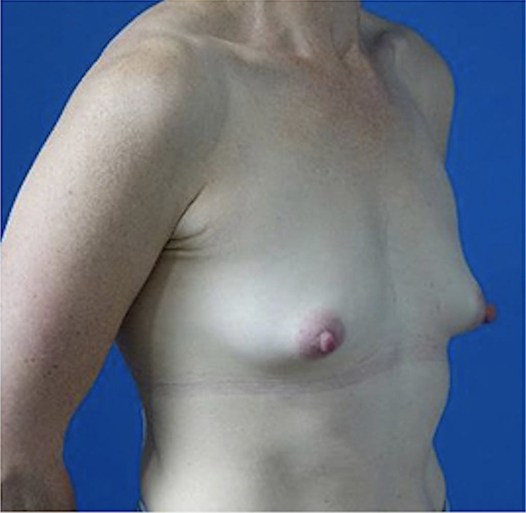 cs1_liposuction_face_before-img