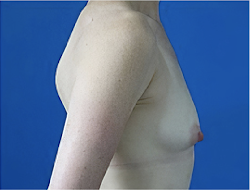 cs1_liposuction_face_before-img