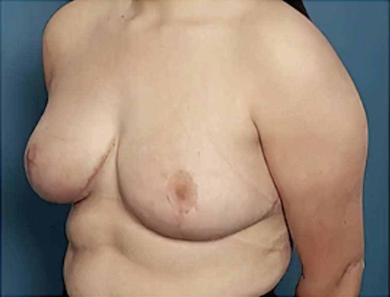 cs1_liposuction_Face_after-img