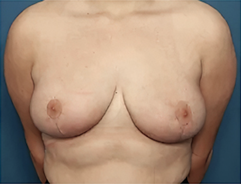 cs1_liposuction_Face_after-img