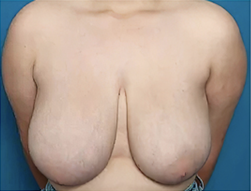 cs1_liposuction_face_before-img