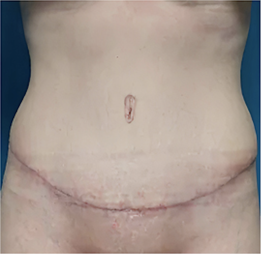 cs1_liposuction_Face_after-img