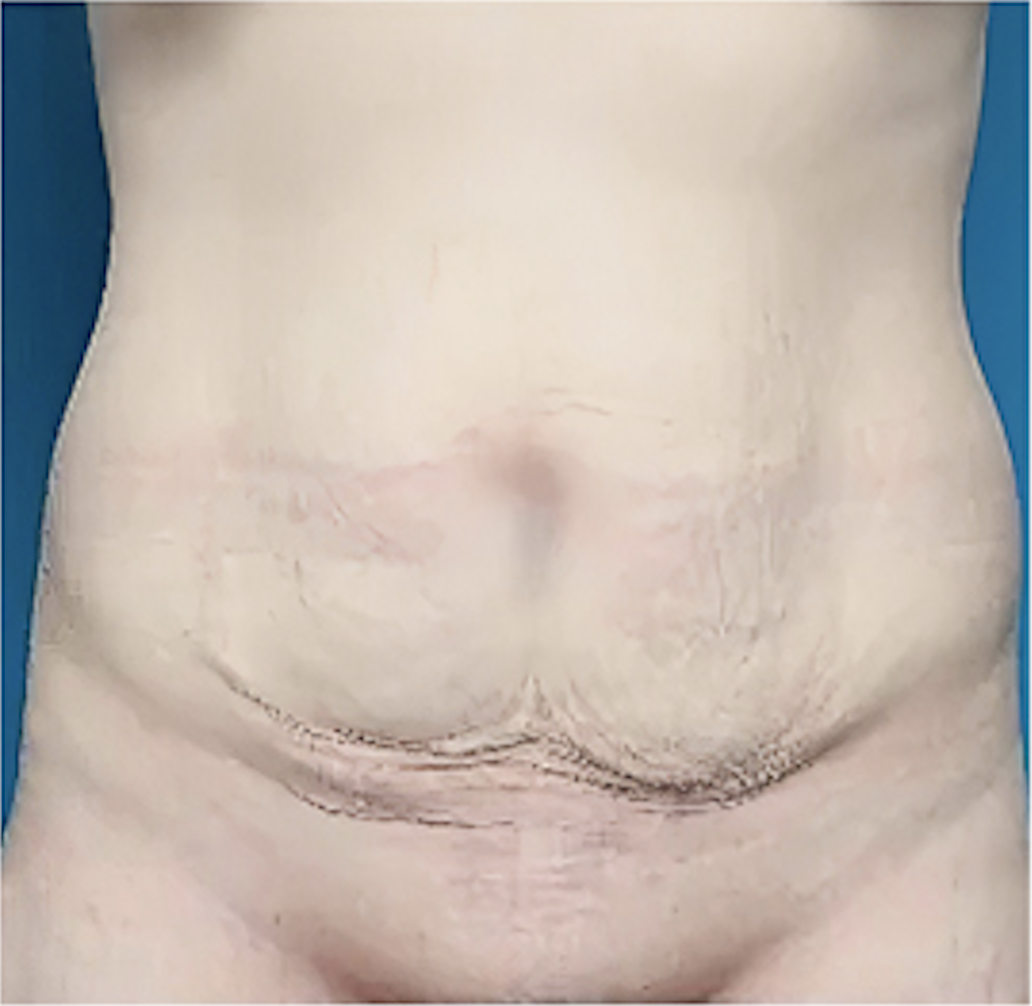cs1_liposuction_face_before-img
